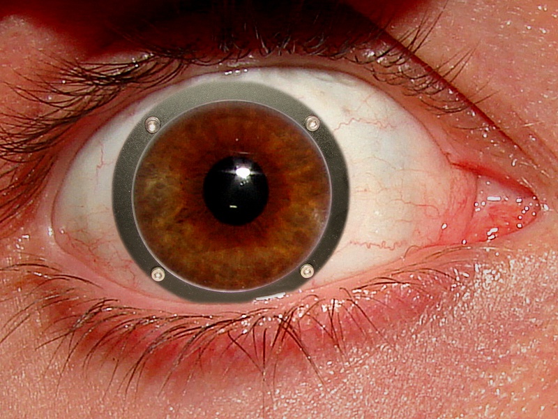 Riattaccamento della retina