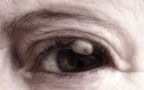 Imperfect Eye Imperfect Eye