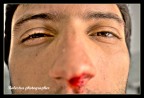 postumi di una rissa postumi di una rissa